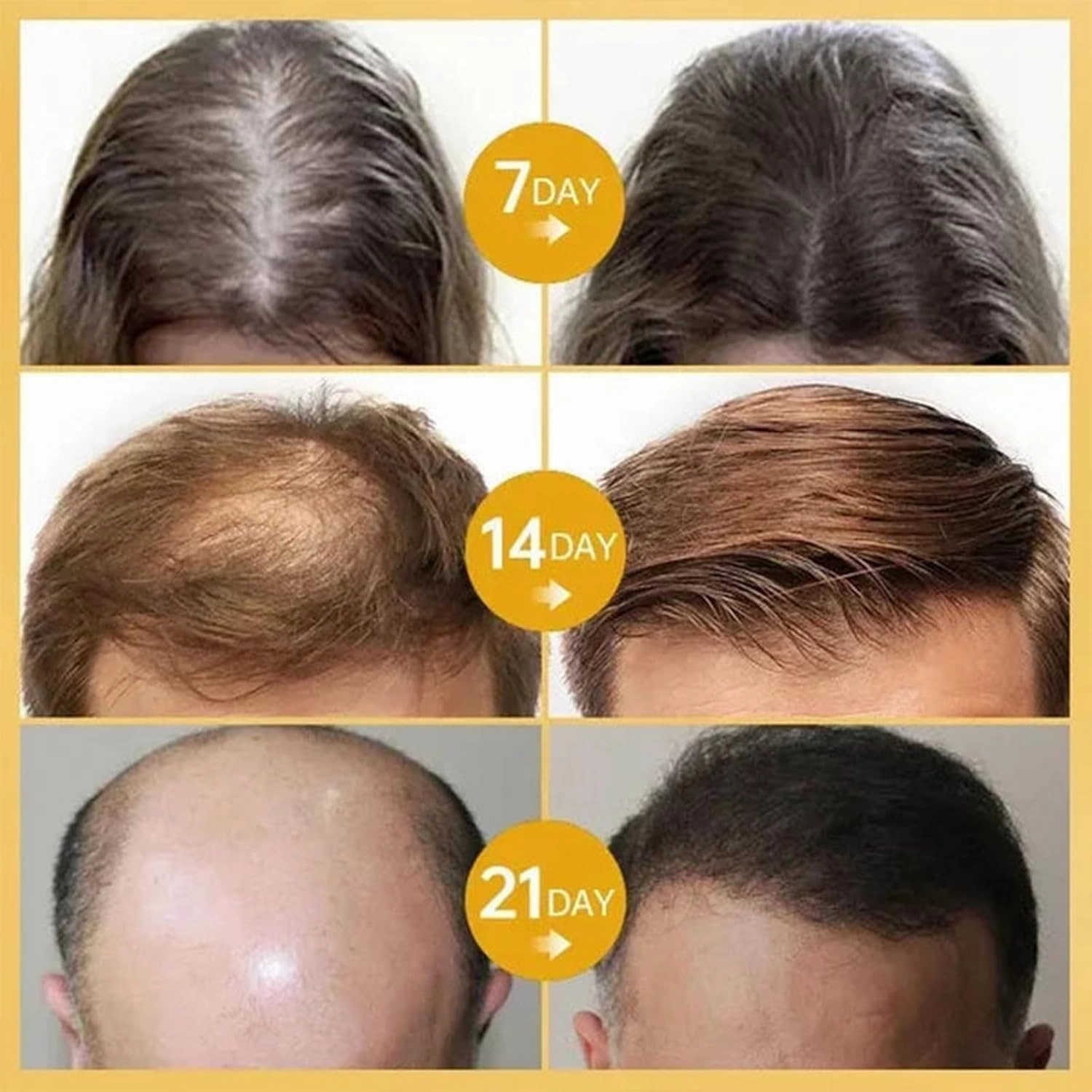LOVILDS Rosemary Hair Growth Essence, Lovilds Rosemary Hair Growth Oil - 2 Ounce, Rosemary Rosemary Hair & Hair Strengthening Oil for All Hair Types (2 Bottles)