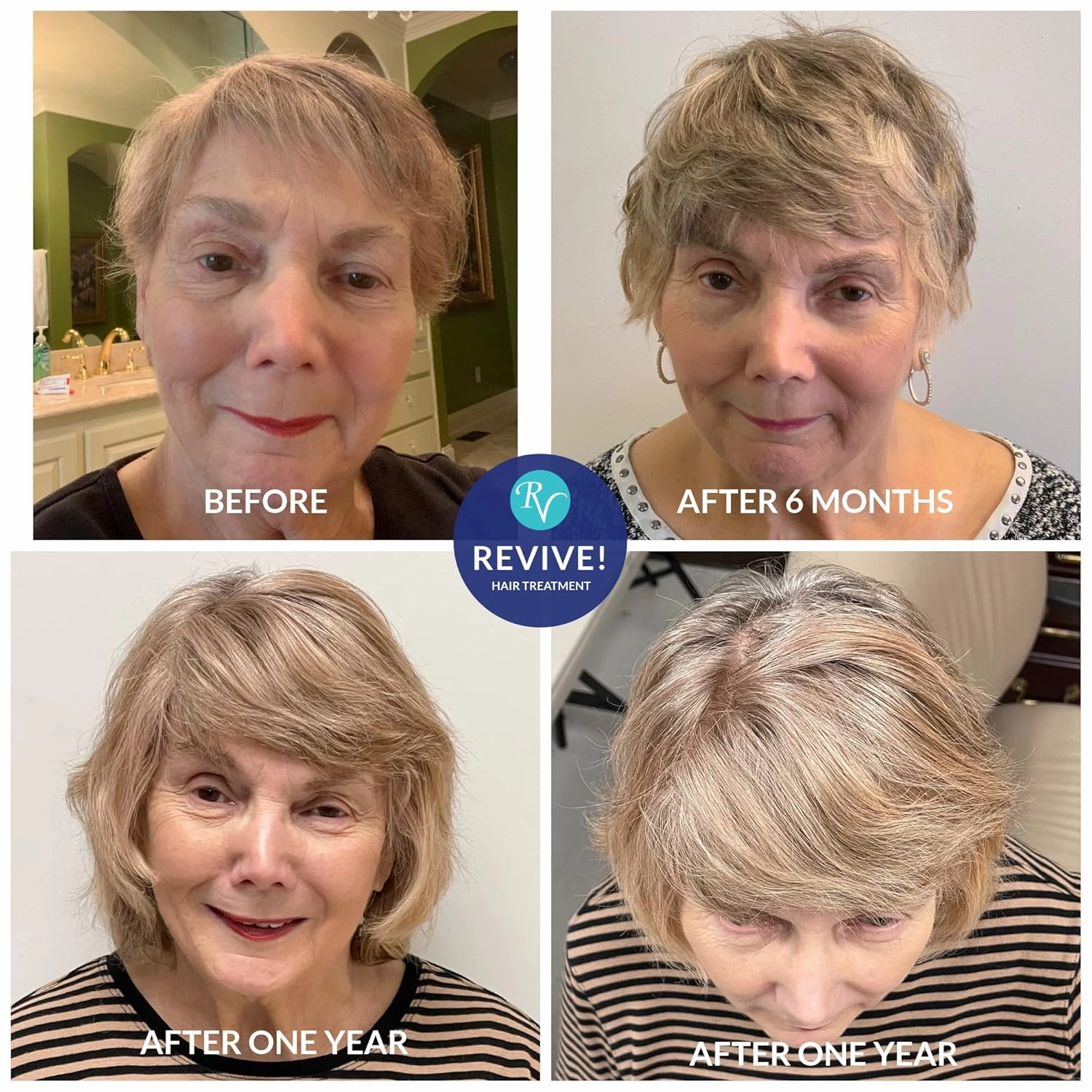 RemeVerse Replenishing Hair Serum - Nourish Scalp & Fortifies Follicle Strand with Redensyl, Infused with Biotin for Thinning Hair and Collagen for Dry Scalp, Densifying Unscented Hair Serum 119 mL